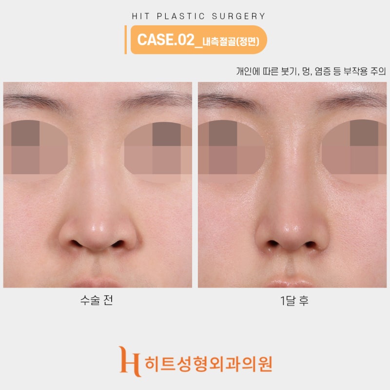 코절골술 휜코에 도움됩니다 사진 3