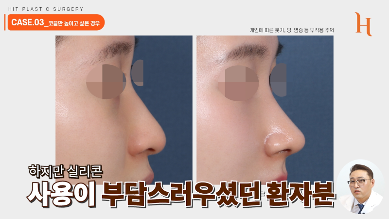 무보형물 코성형 성공하는 조건 사진 6