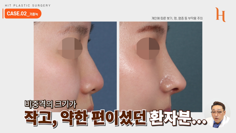 늑연골코수술 재료에 따라 차이가 있을까? 사진 6