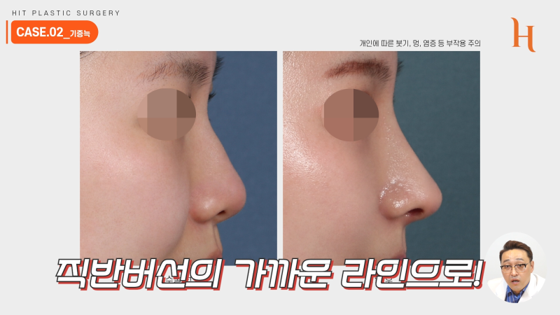 늑연골코수술 재료에 따라 차이가 있을까? 사진 9