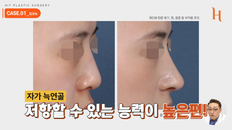 늑연골코수술 재료에 따라 차이가 있을까? 사진 4