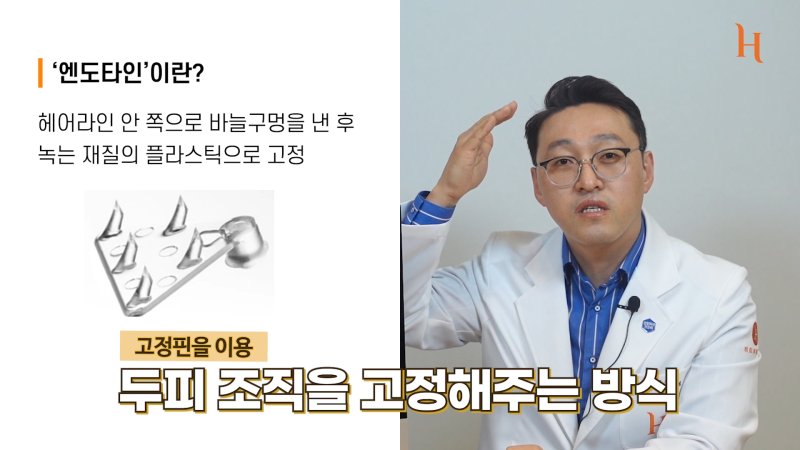 내시경이마거상술 수술방법 2가지 사진 5