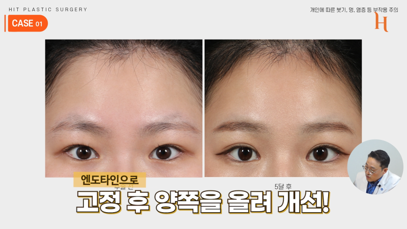 내시경 이마거상 수술 후기 (엔도타인, 본터널링) 사진 4