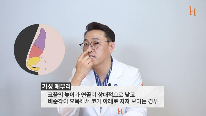 매부리코도 자라난다? 메부리 원인 사진 13