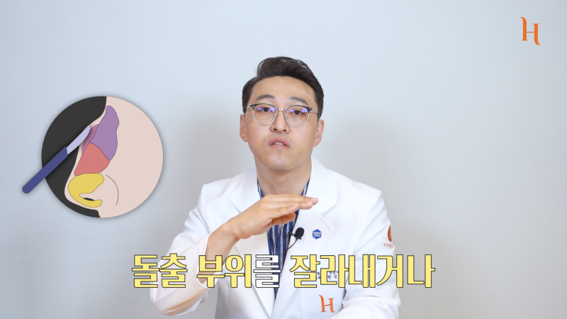 매부리코도 자라난다? 메부리 원인 사진 8