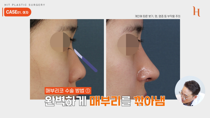 매부리깎기 수술 할 필요 없다? 사진 6