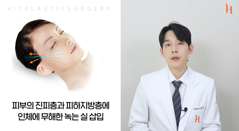 얼굴지방흡입, 실리프팅 : 얼굴살없애는법 사진 9
