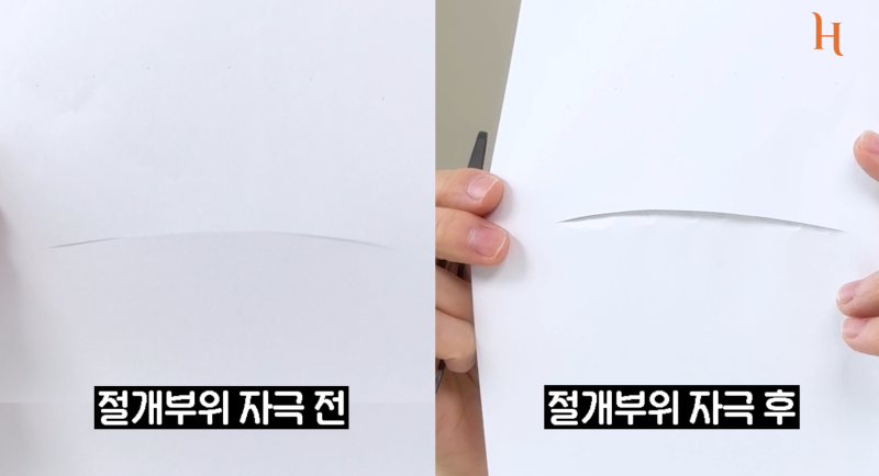 쌍꺼풀수술흉터 이렇게만 관리하세요! (히트성형외과) 사진 5