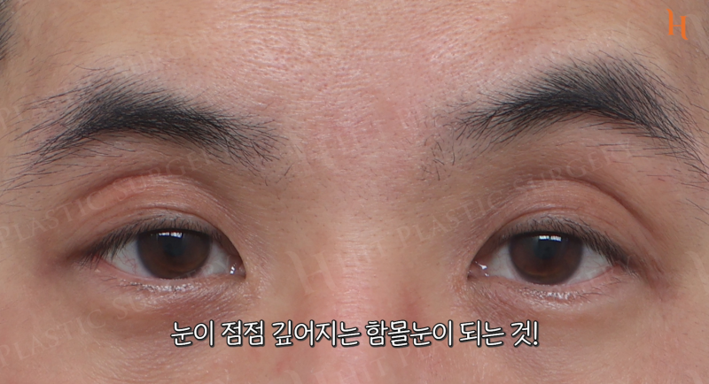 눈위지방이식 꺼진눈 해결 방법 사진 3