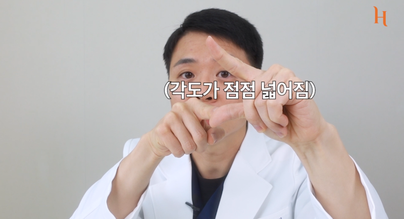 뒤트임 후 ㄷ 흉터 사진 4