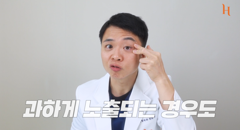 뒤트임 후 ㄷ 흉터 사진 6