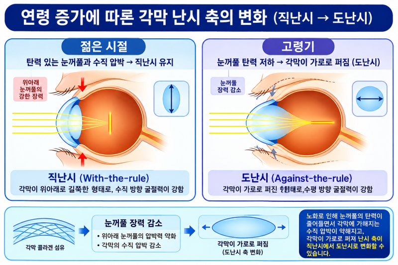 [성모진안과] 안경과 렌즈로도 불편한 '난시' 총정리: 원인부터 스마일라식·실크라식 후 잔여 난시까지 사진 3