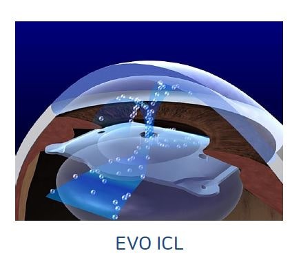 안내 렌즈 삽입술 (ICL)의 모든것❗ 사진 6