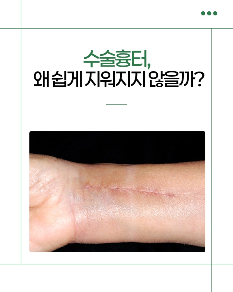 서면울트라펄스알파앙코르, 흉터의 상태에 따라 달라지는 레이저 치료 방법