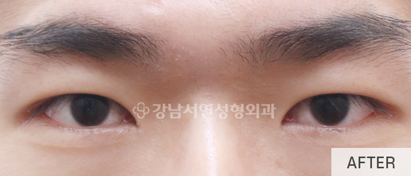 남자눈성형, 무쌍눈매교정 사진 12