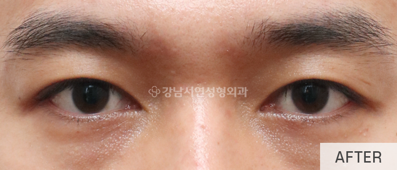 남자눈성형, 무쌍눈매교정 사진 10
