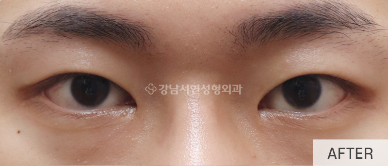 남자눈성형, 무쌍눈매교정 사진 9