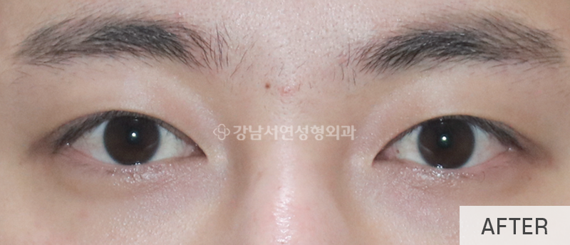 남자눈성형, 무쌍눈매교정 사진 11