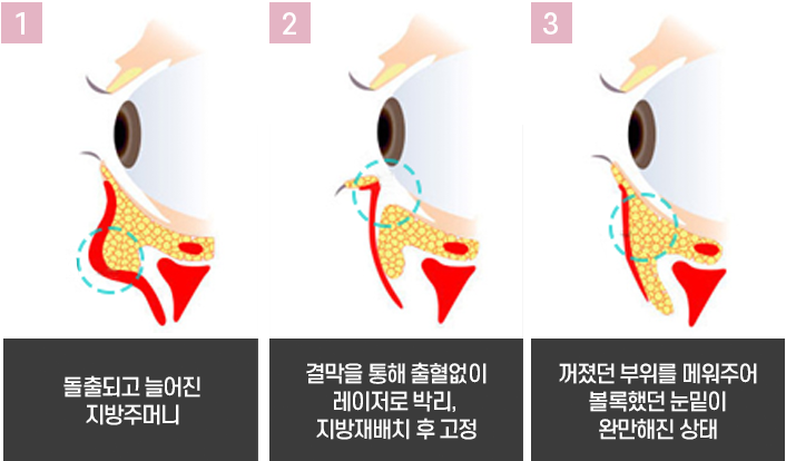 눈밑지방재배치 수술, 하안검 수술 에 대해 알아봅시다.