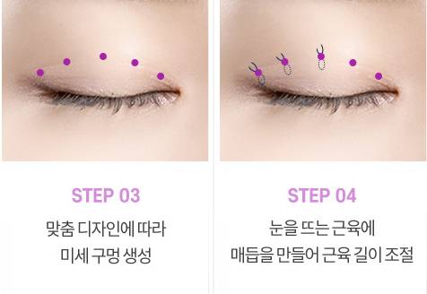 눈매교정 수술로 아름다운 눈모양 만들기 사진 4