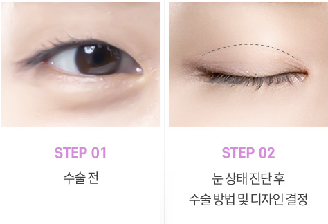 눈매교정 수술로 아름다운 눈모양 만들기