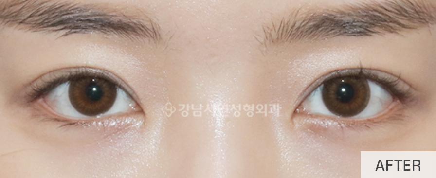 눈매교정 수술로 아름다운 눈모양 만들기 사진 12