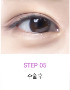 눈매교정 수술로 아름다운 눈모양 만들기 사진 5