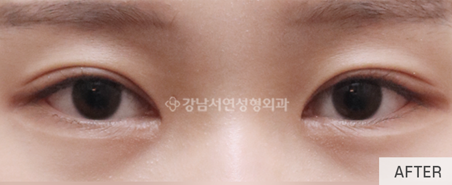 눈매교정 수술로 아름다운 눈모양 만들기 사진 9