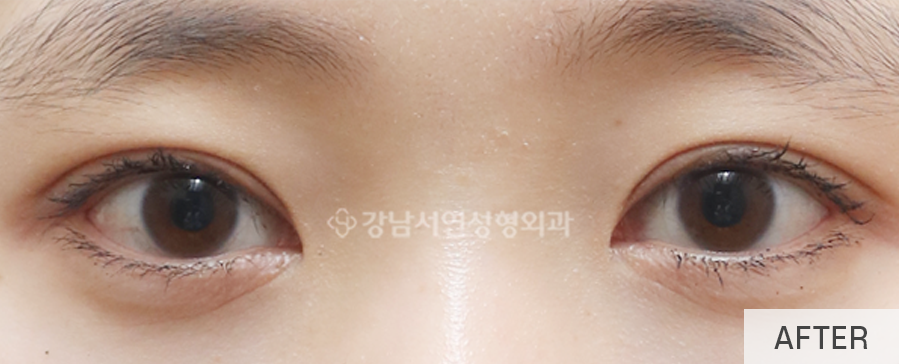 눈매교정 수술로 아름다운 눈모양 만들기 사진 10