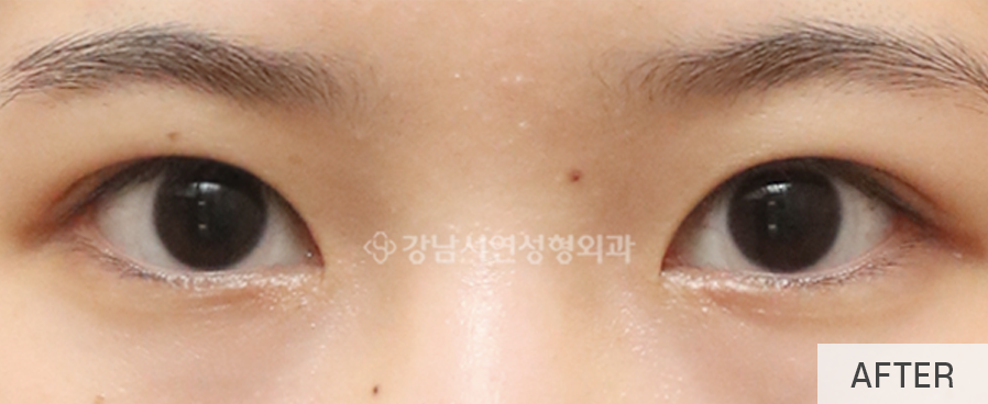 눈매교정 수술로 아름다운 눈모양 만들기 사진 11