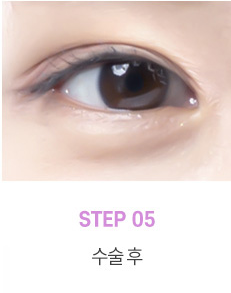 눈매교정 수술로 아름다운 눈모양 만들기 사진 8
