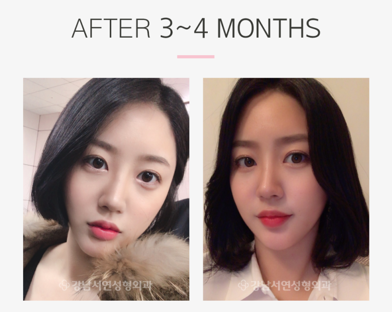 Kisah Nyata Gangnam Seoyeon Plastic Surgery: Koreksi Mata (Operasi Ulang) + Rhinoplasty + Fat Graft (Dahi)