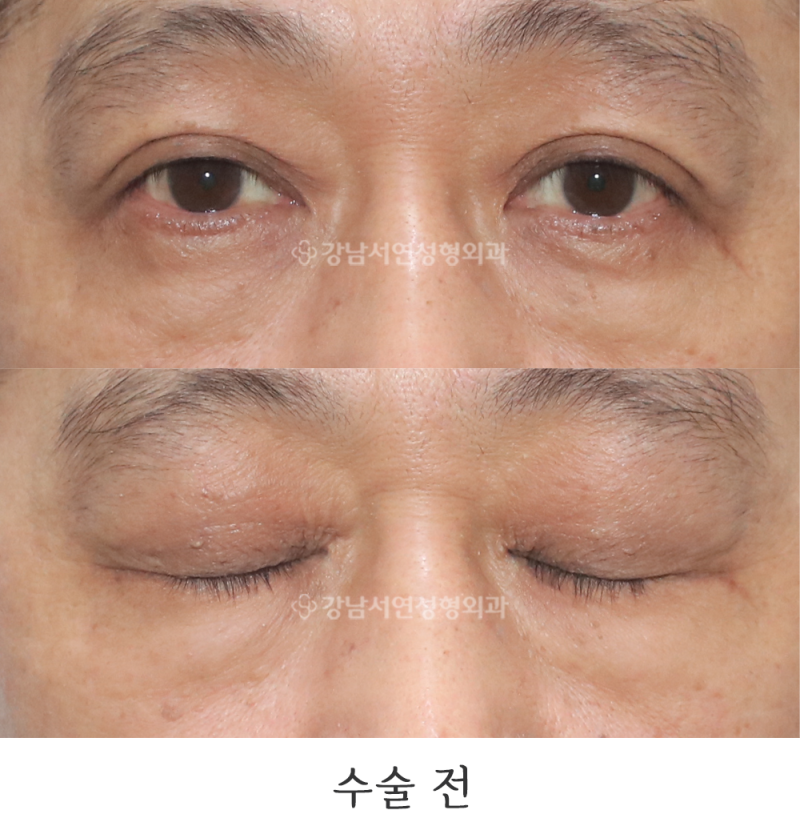 Removing Double Eyelids: Monolid Ptosis Correction Photos