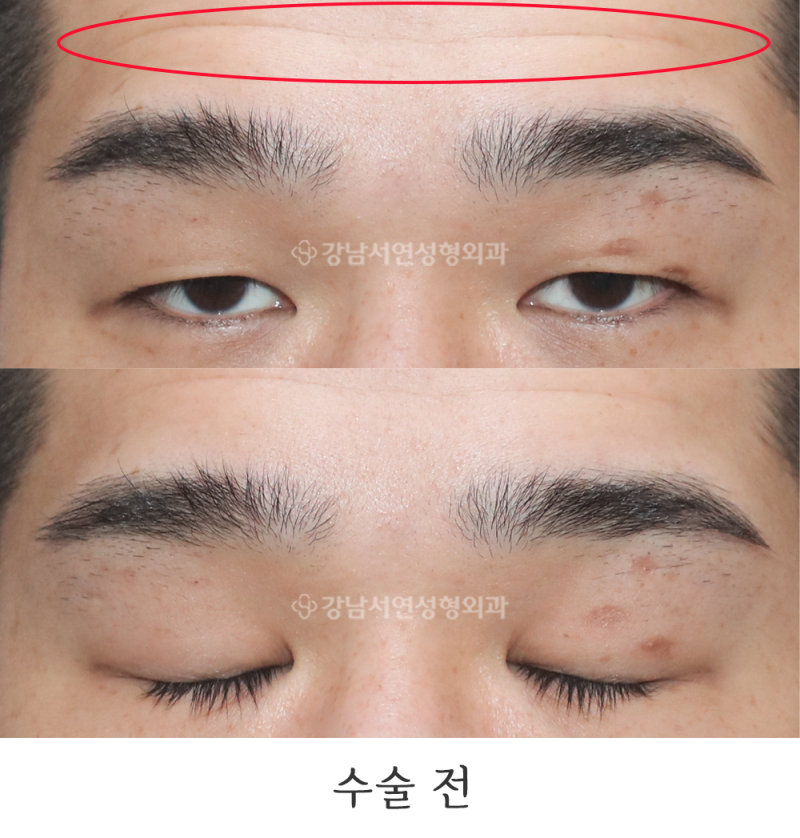 Men’s Monolid Ptosis Correction Photos (feat. Gangnam Seoyeon Plastic Surgery)
