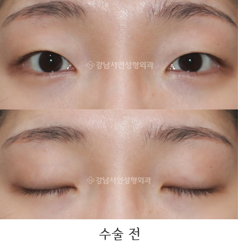 자연유착(매몰 쌍꺼풀) 한 달 전후 사진(feat.강남서연성형외과)
