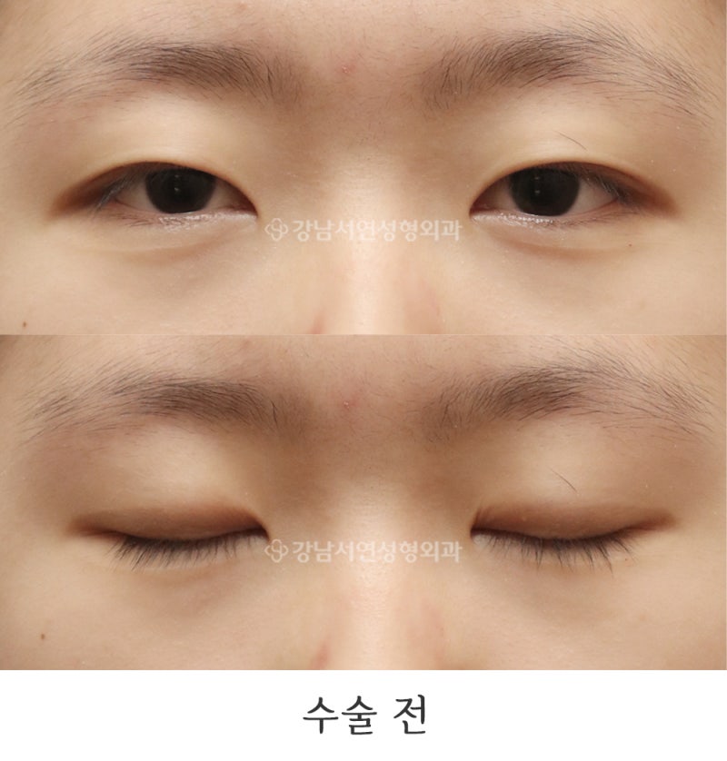 Incisional Ptosis Correction and Epicanthoplasty: 6-Month Before & After Photos (feat. Gangnam Seoyeon Plastic Surgery)