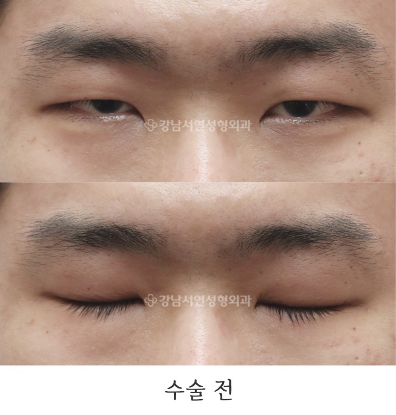 Men’s Non-incisional Ptosis Correction and Epicanthoplasty: 6-Month Before & After (feat. Gangnam Seoyeon Plastic Surgery)