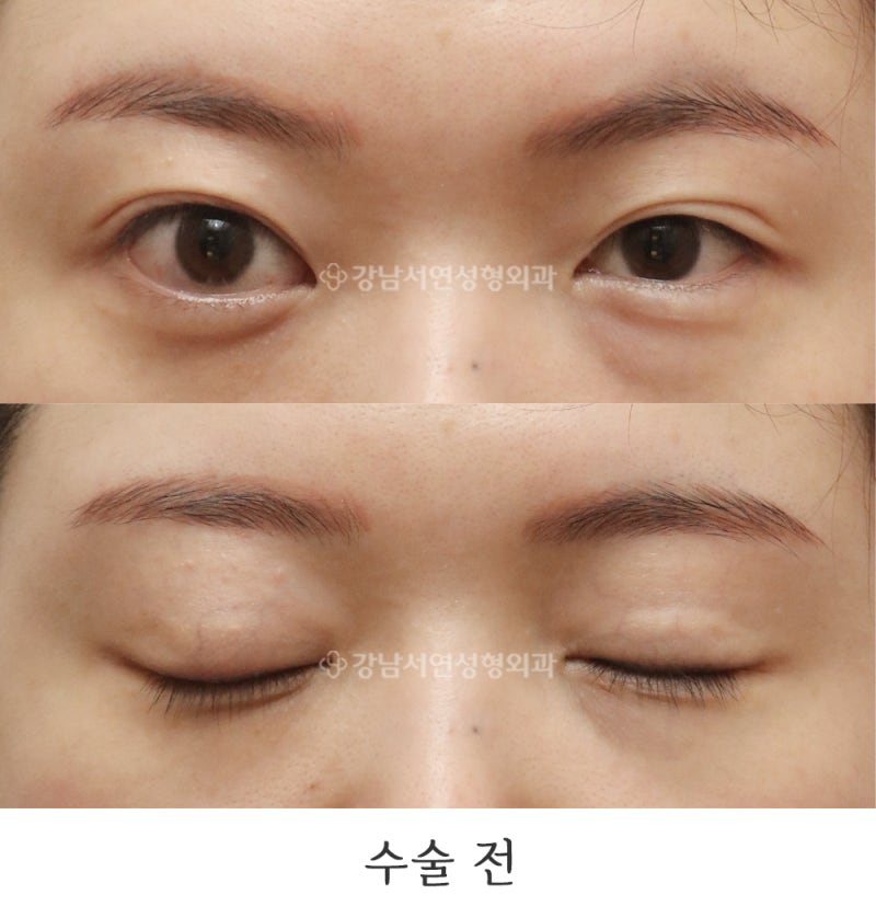 Incisional Ptosis Correction Revision: 6-Month Before & After Photos (feat. Gangnam Seoyeon Plastic Surgery)