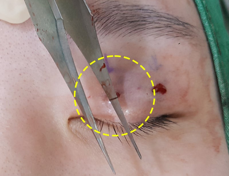 Buried Suture Removal: 1-Month Before and After Photos (feat. Gangnam Seoyeon Plastic Surgery)