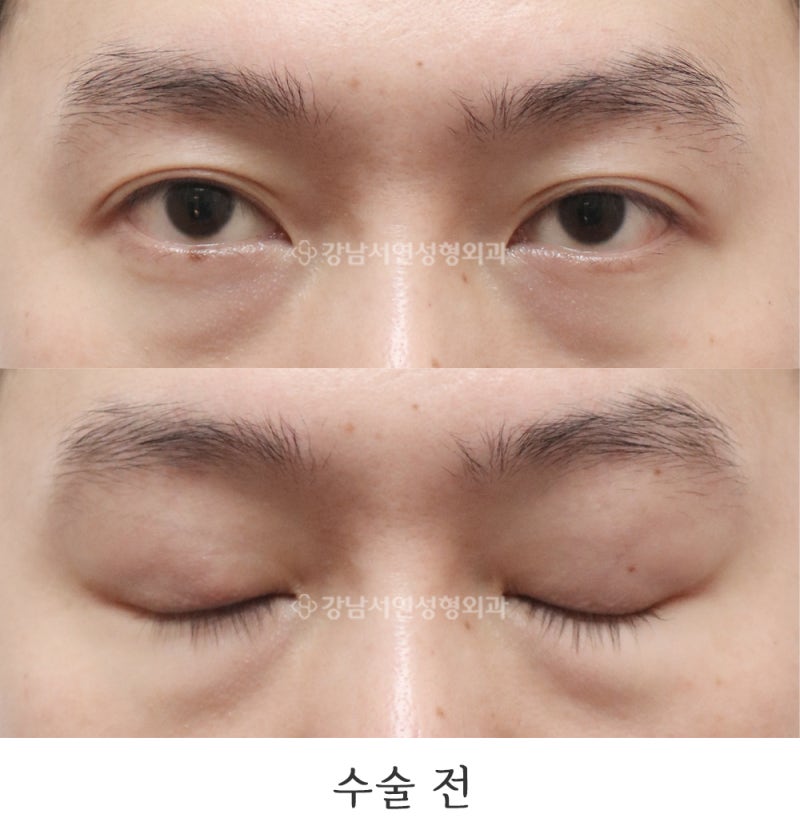 Double Eyelid Removal and Monolid Ptosis Correction: 6-Month Before & After (Gangnam Seoyeon Plastic Surgery)