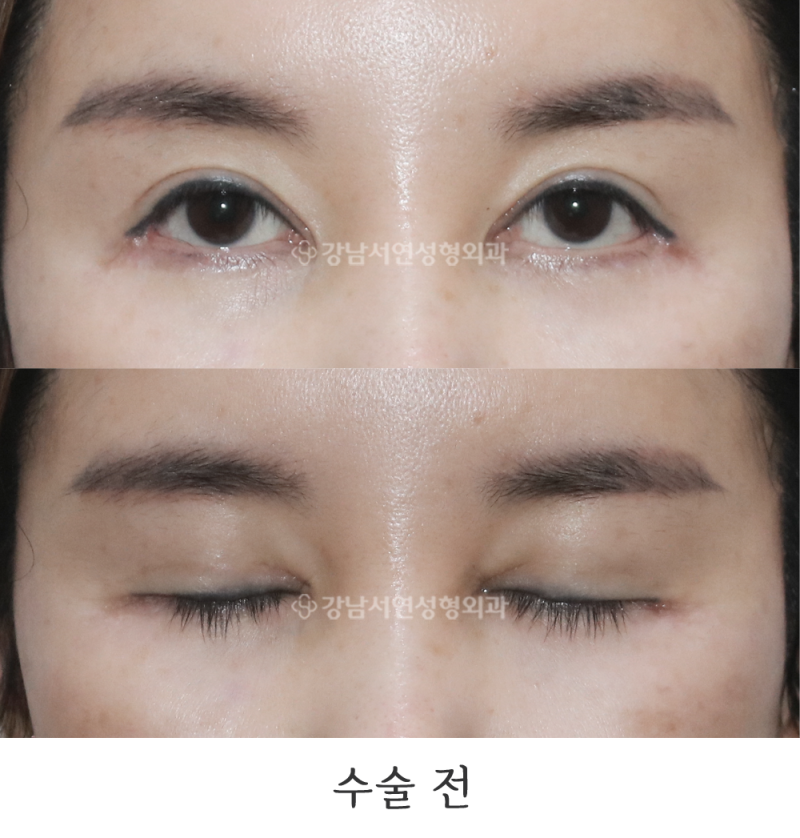 Epicanthoplasty Revision 1-Year Before & After Photos (feat. Gangnam Seoyeon Plastic Surgery)