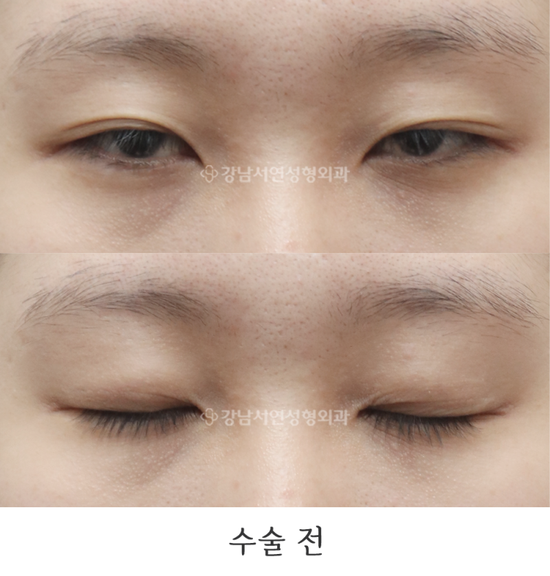 Incisional Ptosis Correction, Epicanthoplasty, and Lateral Canthoplasty: 6-Month Before & After (feat. Gangnam Seoyeon Plastic Surgery)