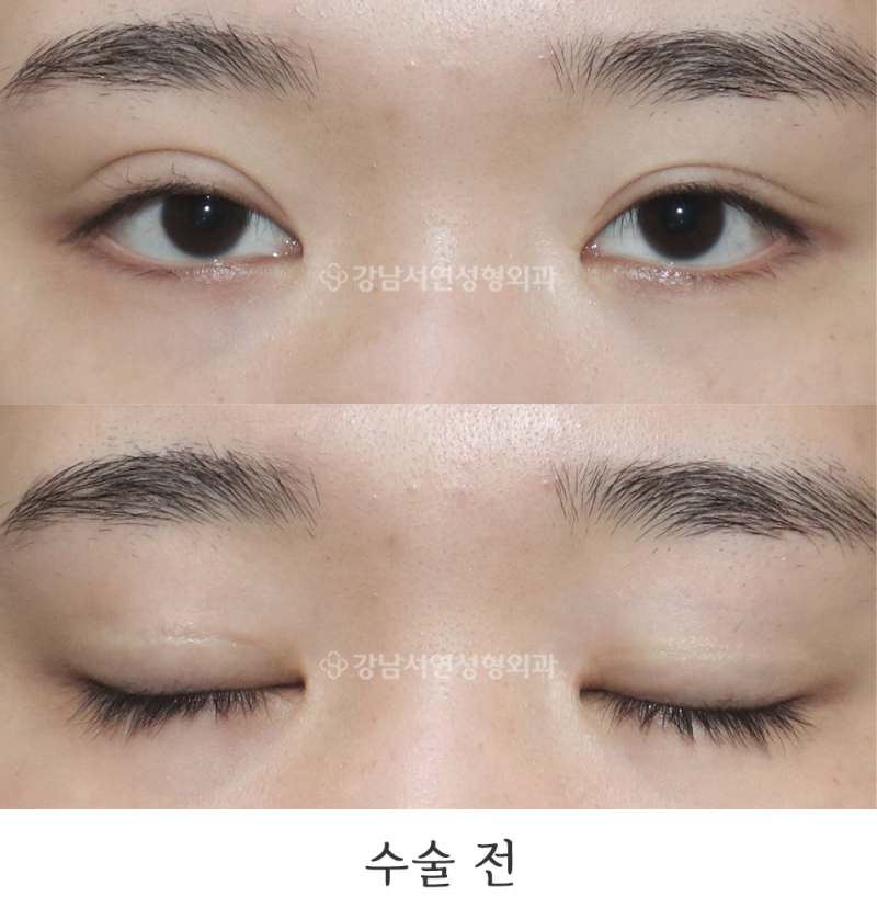 Revision Eyelid Surgery: Skin-Sparing Incision (Dujulttagi) 1-Week and 6-Month Before & After (feat. Gangnam Seoyeon Plastic Surgery)