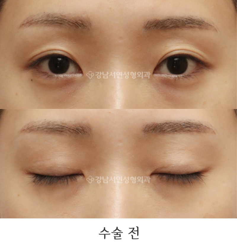 Female Double Eyelid Revision Surgery: 6-Month Before & After Photos (feat. Gangnam Seoyeon Plastic Surgery)