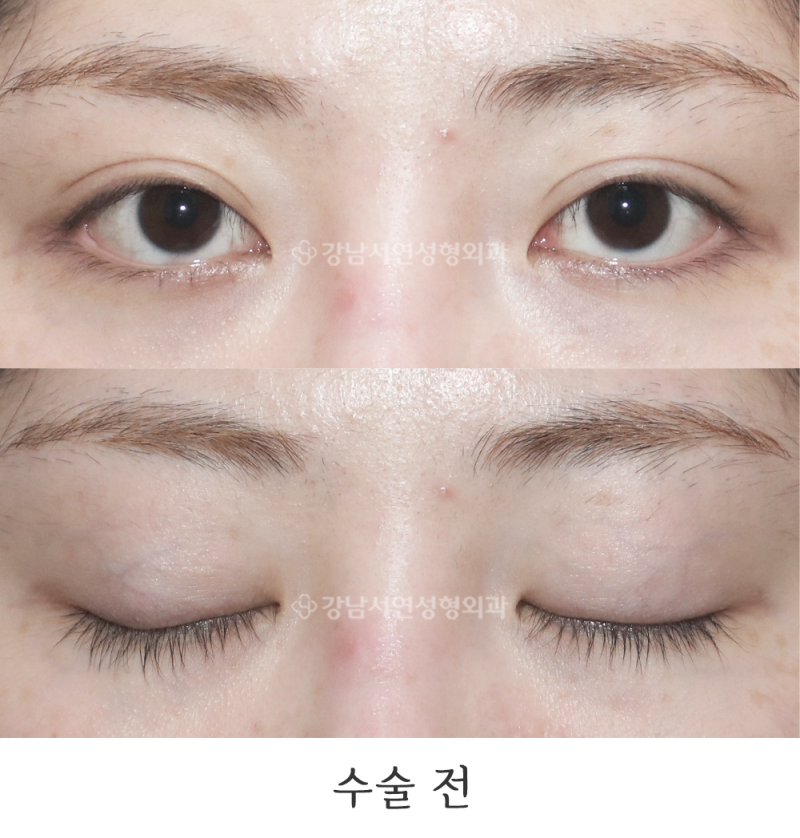 Gangnam Seoyeon Plastic Surgery: Double Eyelid Line Lowering Revision Before & After Photos
