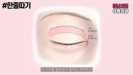 A Detailed Look at the 'Two-Line Method' (Dujulttagi) for Eyelid Revision