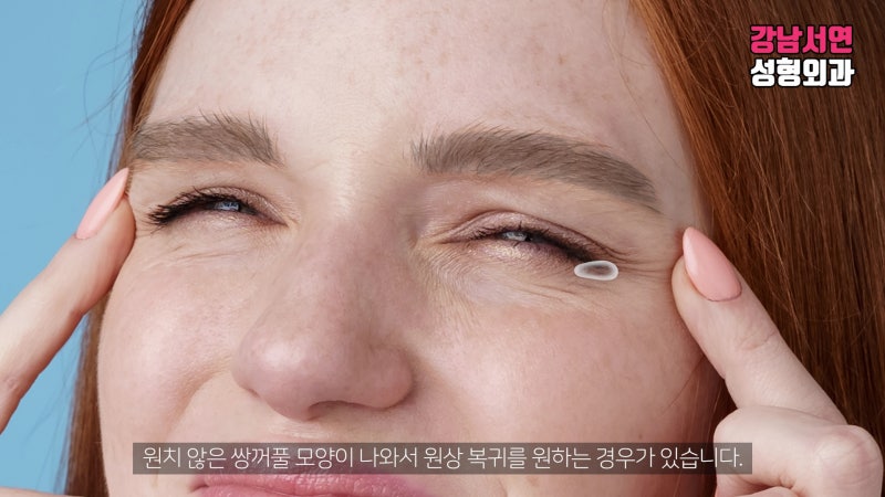 A Comprehensive Guide to Suture Removal and Undoing Non-Incisional Double Eyelid Surgery
