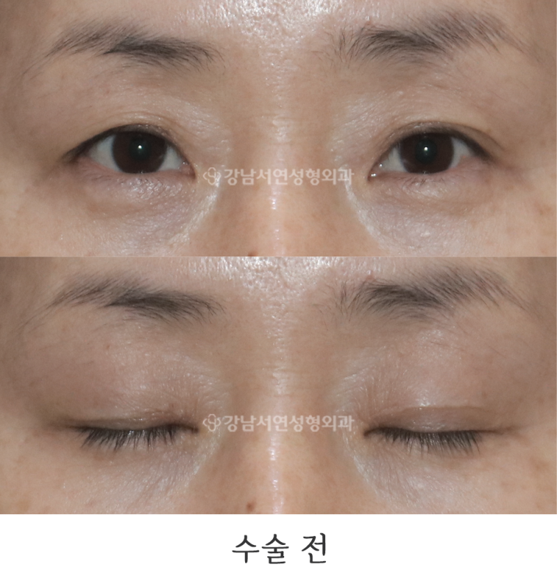 Gangnam Seoyeon Plastic Surgery: Upper Blepharoplasty and Dual Canthoplasty Before & After Photos