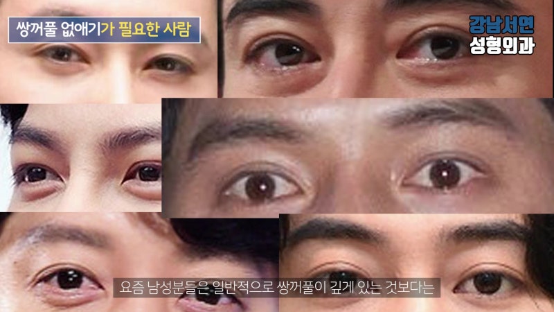 Male Double Eyelid Removal: Surgical Methods, Precautions, and Before & After Photos