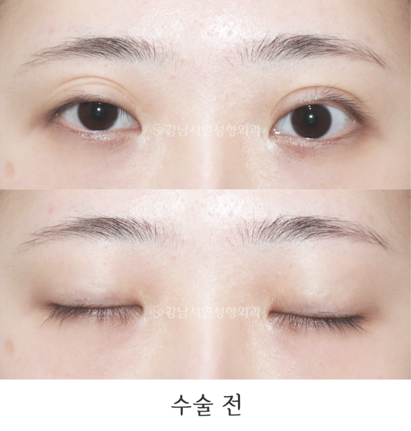 Gangnam Seoyeon Plastic Surgery: Double Eyelid Revision (Mucosal Exposure & Asymmetry Correction) Before & After